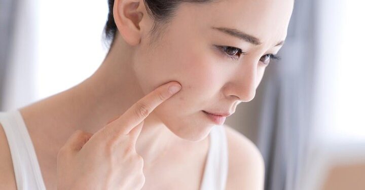 3 Tips Atasi Jerawat Pustula Akibat Pori-Pori Tersumbat, Dijamin Work!