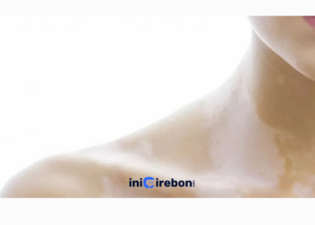 Cara Menghilangkan Panu Ampuh