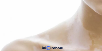 Cara Menghilangkan Panu Ampuh